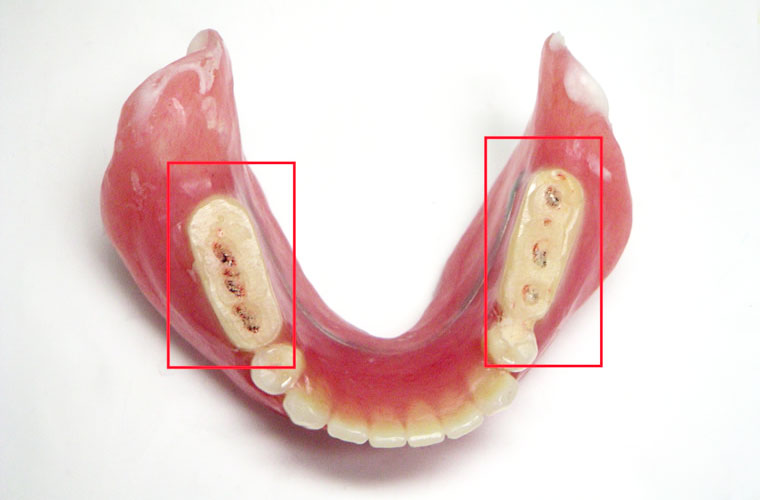 診断用義歯でより適切な入れ歯へ