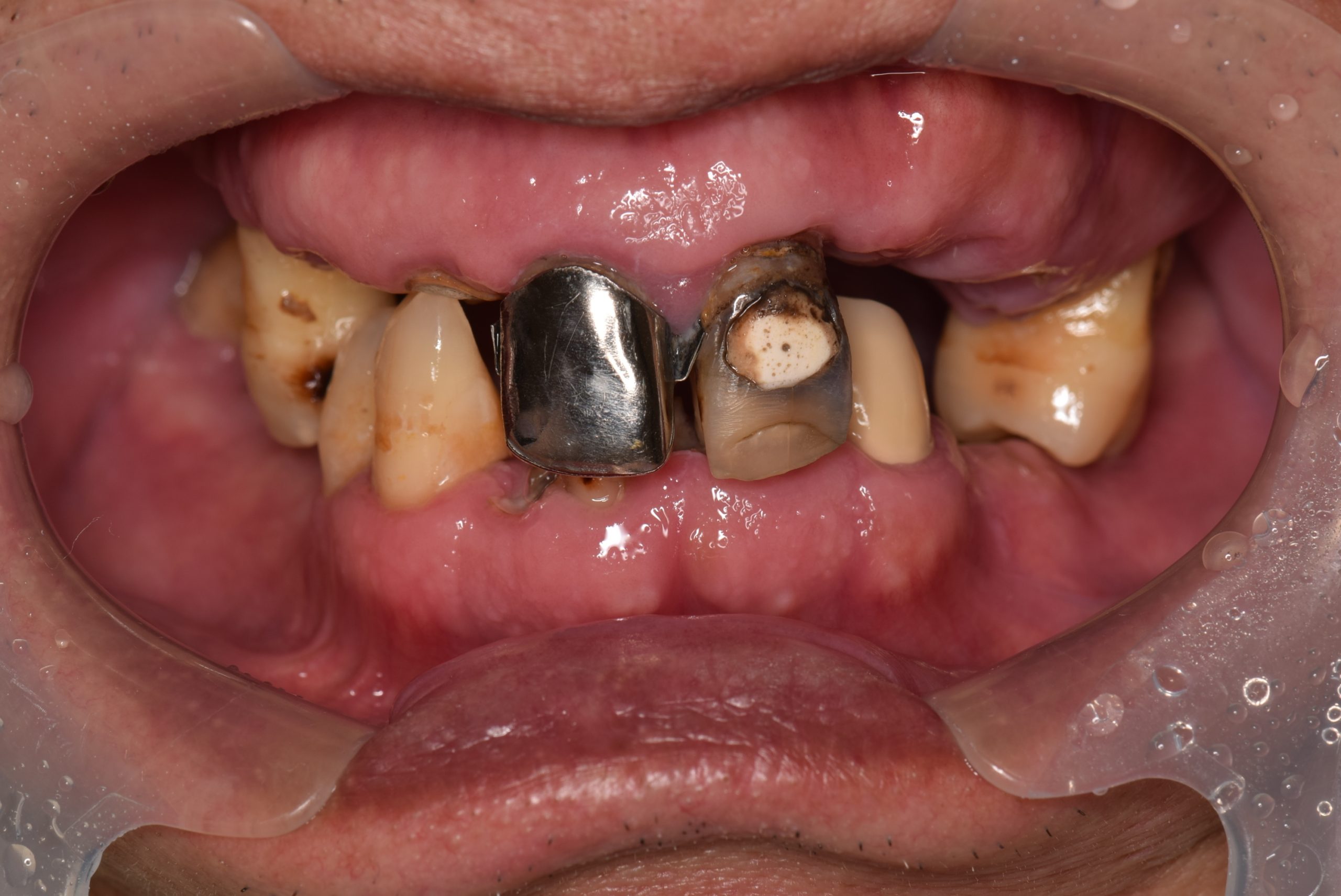 歯 が ボロボロ に なる 原因